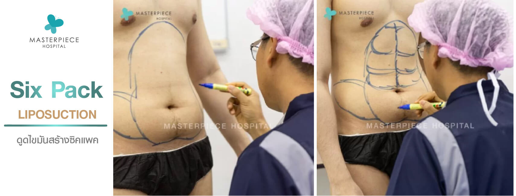 six pack liposuction