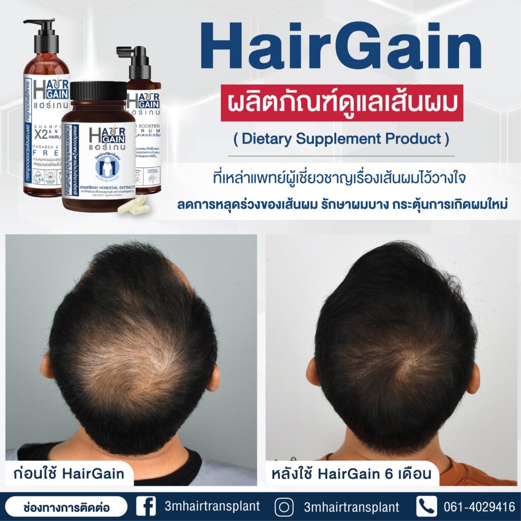 HairGain ผลิตภัณฑ์ดูแลเส้นผม