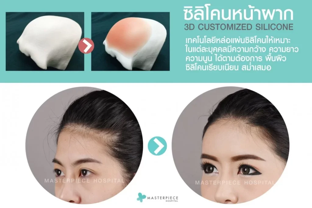 ซิลิโคนหน้าผาก 3D Customized Silicone Implant