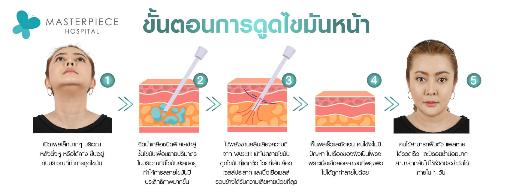 ขั้นตอนการดูดไขมันหน้า
1. ผู้หญิงเงยหน้าขึ้นให้เห็นบริเวณที่จะดูไขมันเหนียง
2. จำลองชั้นผิวหนังและเข็มฉีดยาฉีดน้ำเกลือเพื่อเตรียมการดูดไขมัน
3. จำลองชั้นผิวหนังไขมัน ใช้คลื่นเสียงความถี่จากเครื่อง Vaser เข้าไปสลายไขมันโดยเส้นเลือดและเซลล์ประสาทได้รับความเสียหายน้อยที่สุด
4. จำลองชั้นผิวหนังและไขมันหลังทำการดูไขมัน เห็นผลชัดเจน
5. ผู้หญิงหน้าตรงเหนียงลดจนแทบไม่เห็น แผลหายไว พักฟื้น 1 วัน