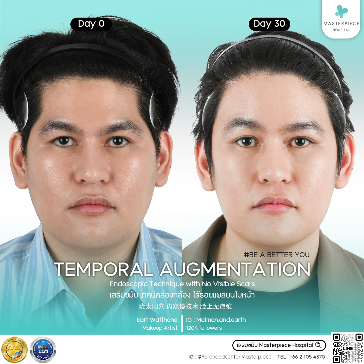 รีวิว เสริมขมับกับโรงพยาบาลมาสเตอร์พีช