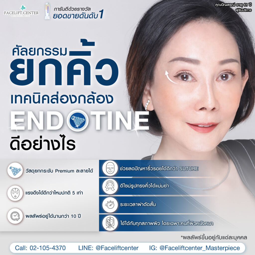 ยกคิ้ว เทคนิคส่องกล้อง Endotine