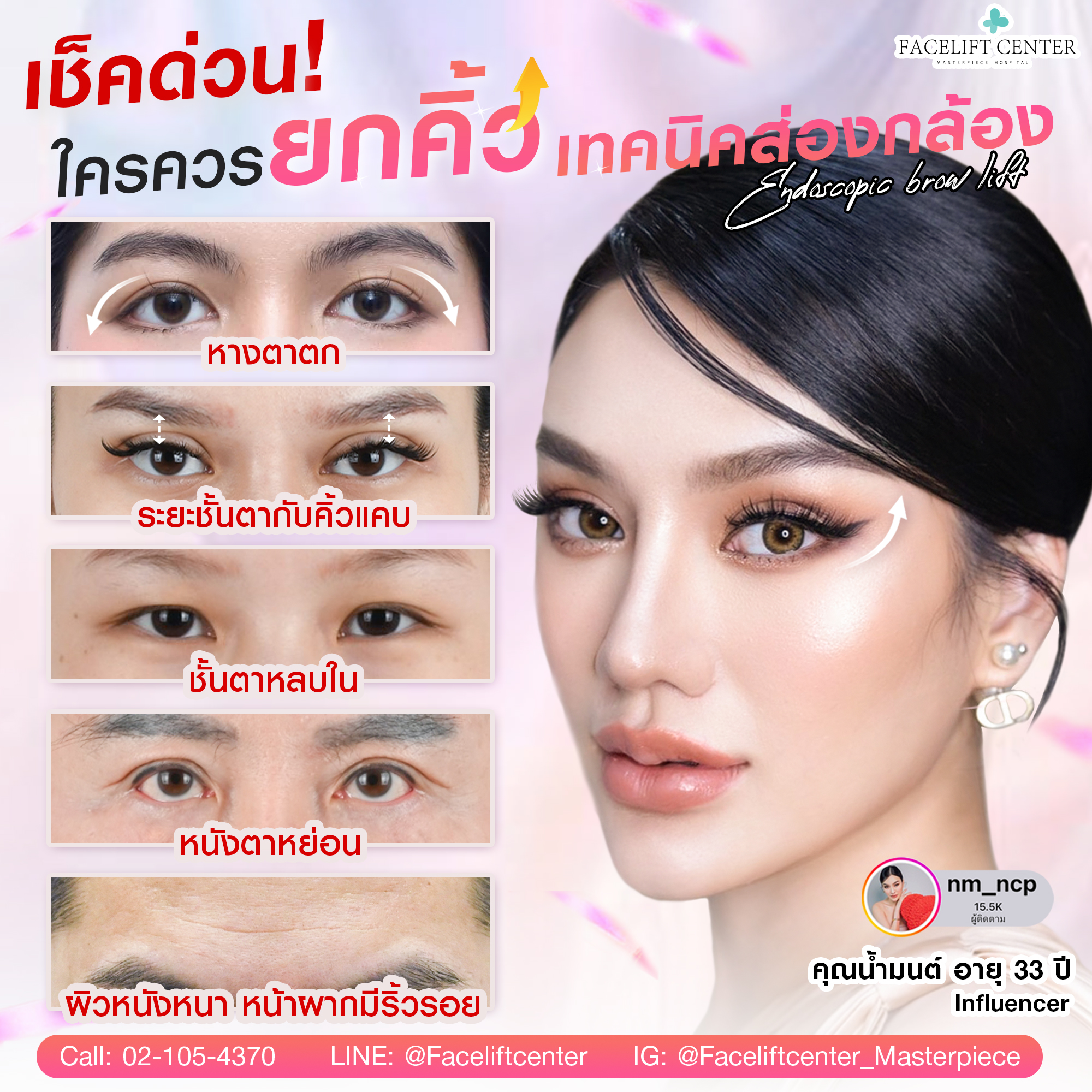 Endotine ยกคิ้วส่องหล้อง