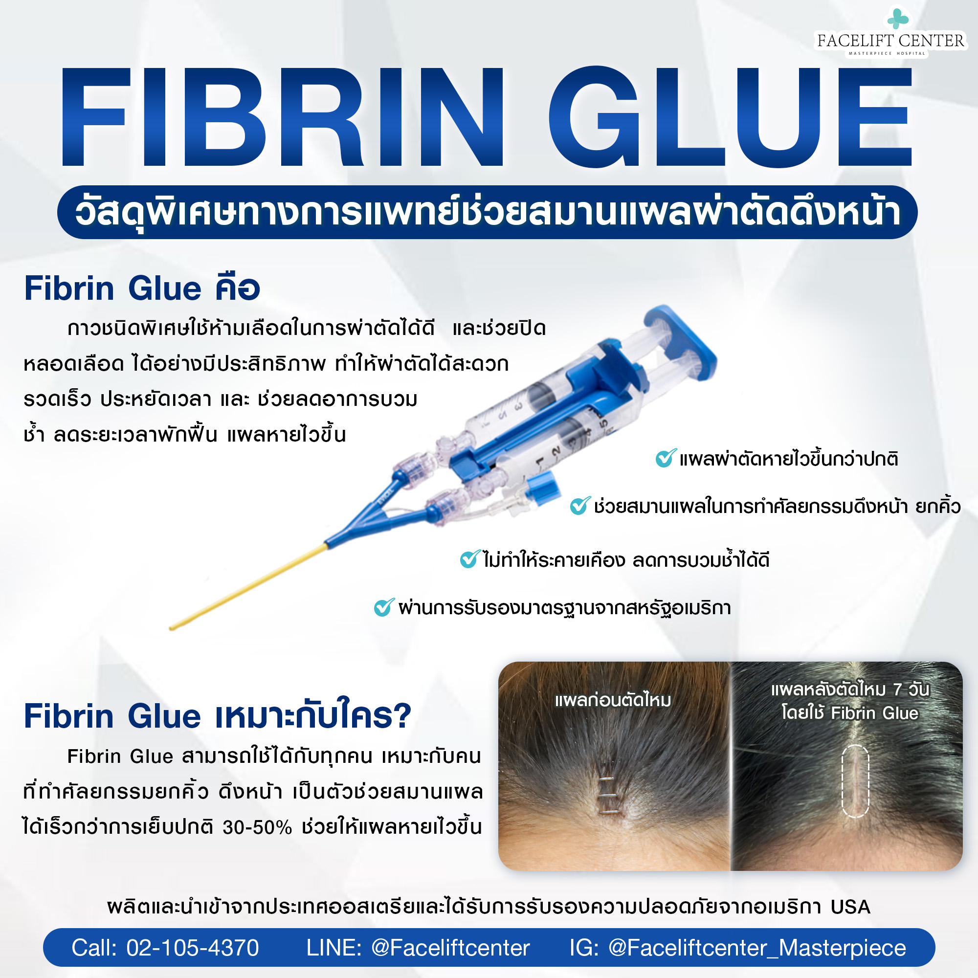 Fibrin glue
