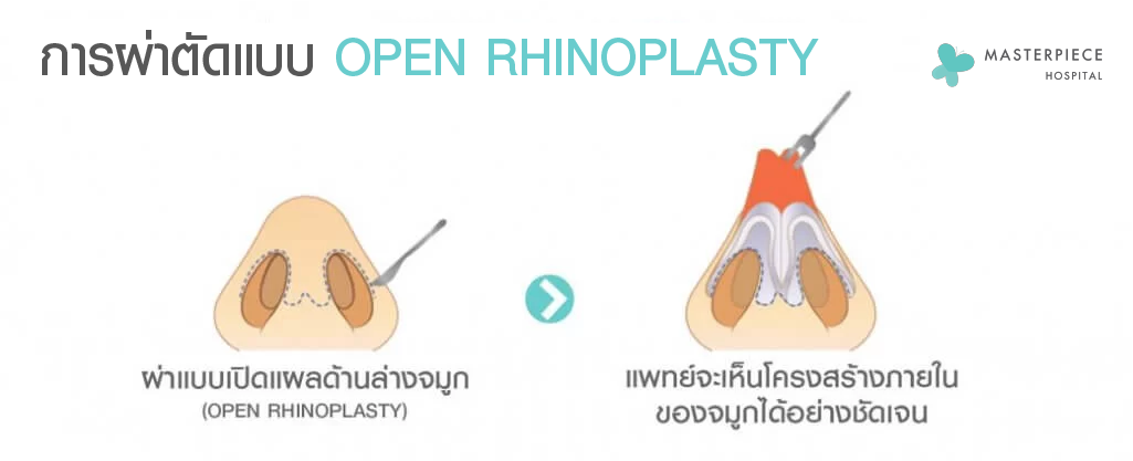 การผ่าตัดแบบ OPEN RHINOPLASTY