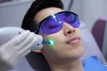 Laser V Beam ช่วยเรื่องรอยแดงจากสิว รอยแลเป็น