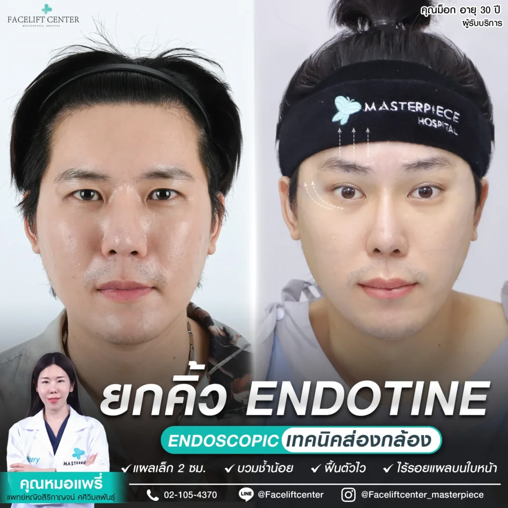 ยกคิ้ว เทคนิคส่องกล้อง Endotine แก้ปัญหาริ้วรอยบนใบหน้า เผยตาสวย