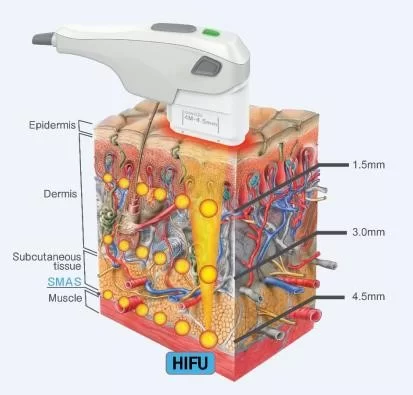 ลักษณะการทำงานของคลื่น Ultrasound Hifu ยกกระชับปรับรูปหน้า