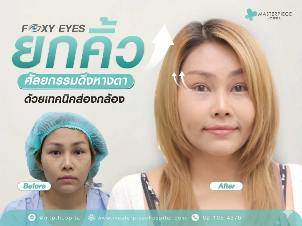 FOXY EYES ศัลยกรรมดึงหางตา