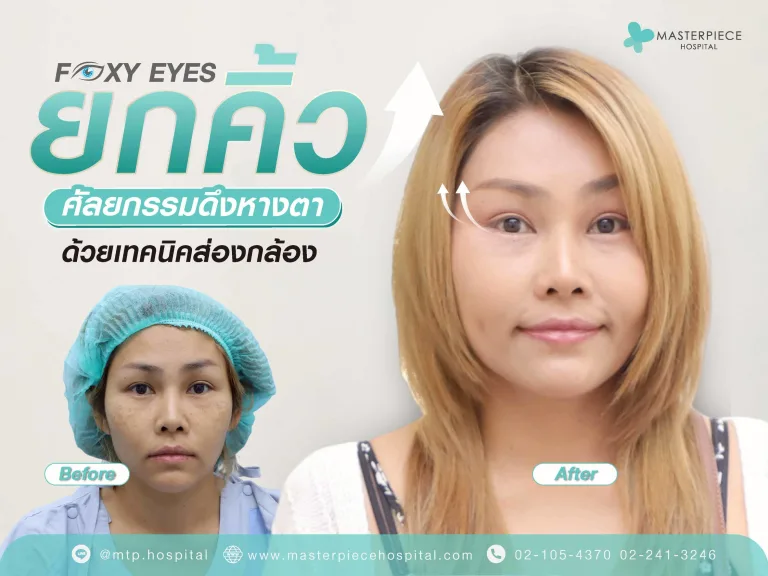 FOXY EYES ศัลยกรรมดึงหางตาด้วยเทคนิคส่องกล้อง แผลเล็กเจ็บน้อย