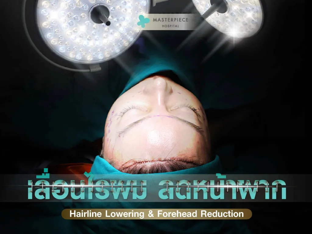 เลื่อนไรผมลดหน้าผากเป็นศัลยกรรมที่แก้ปัญหาหน้าผากเถิก หน้าผากกว้าง