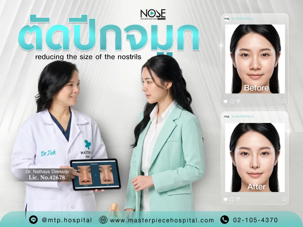 ตัดปีกจมูก
