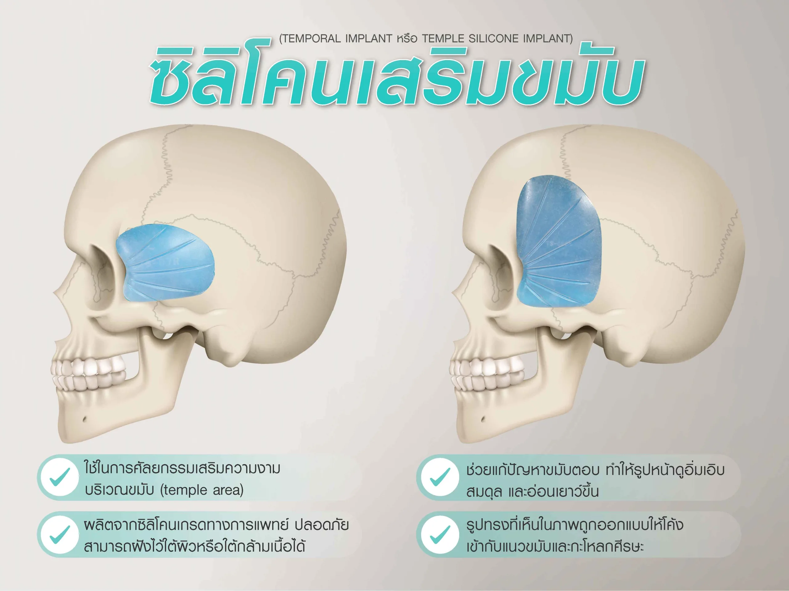 เสริมขมับด้วยซิลิโคนคืออะไร?