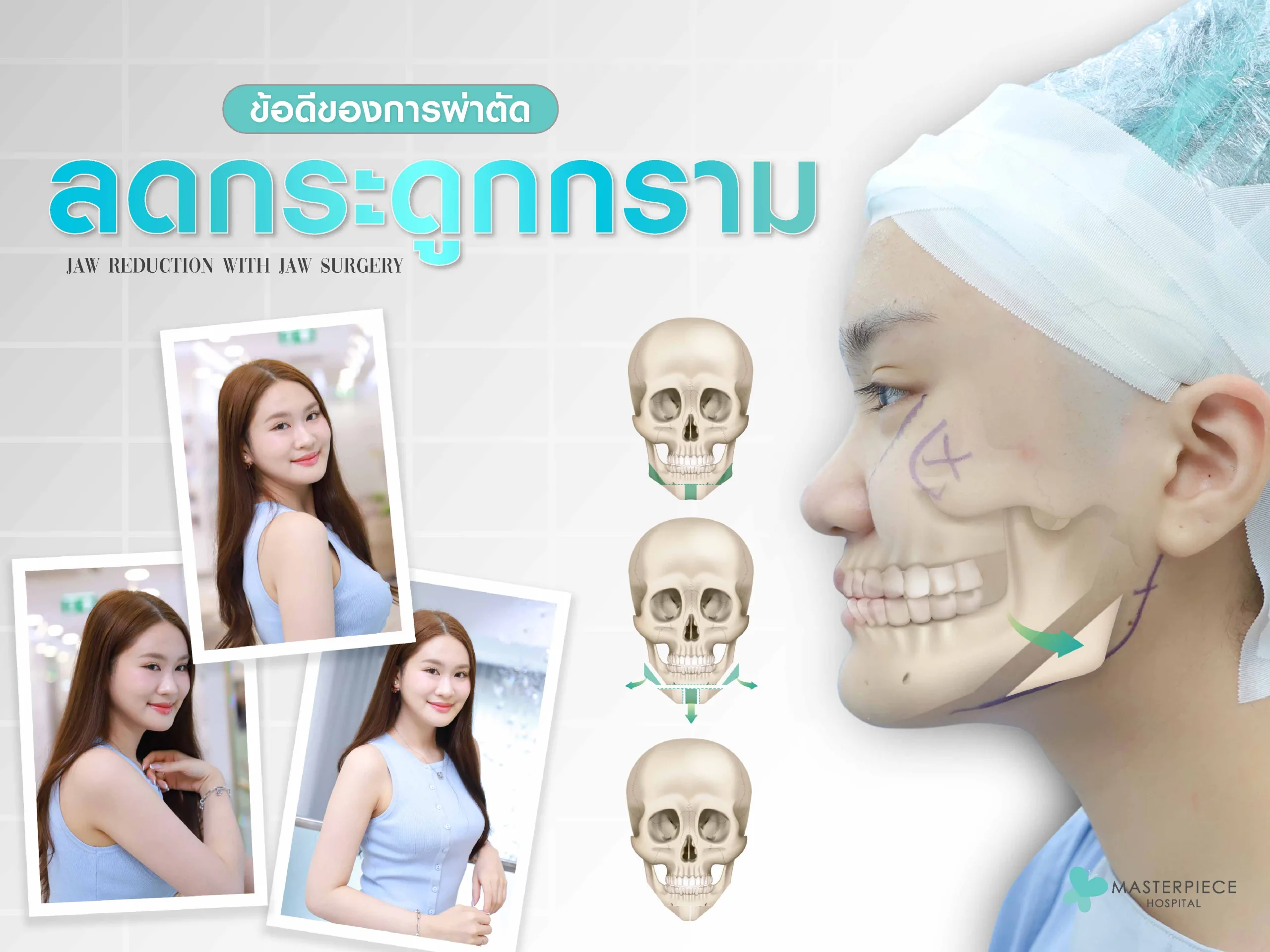 ข้อดีของการผ่าตัดลดกระดูกกราม