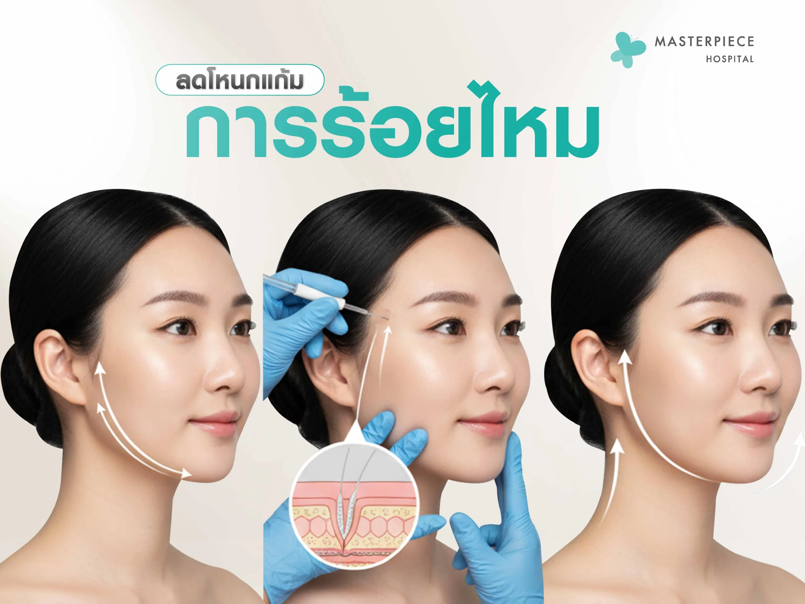 ลดโหนกแก้มด้วยการร้อยไหม