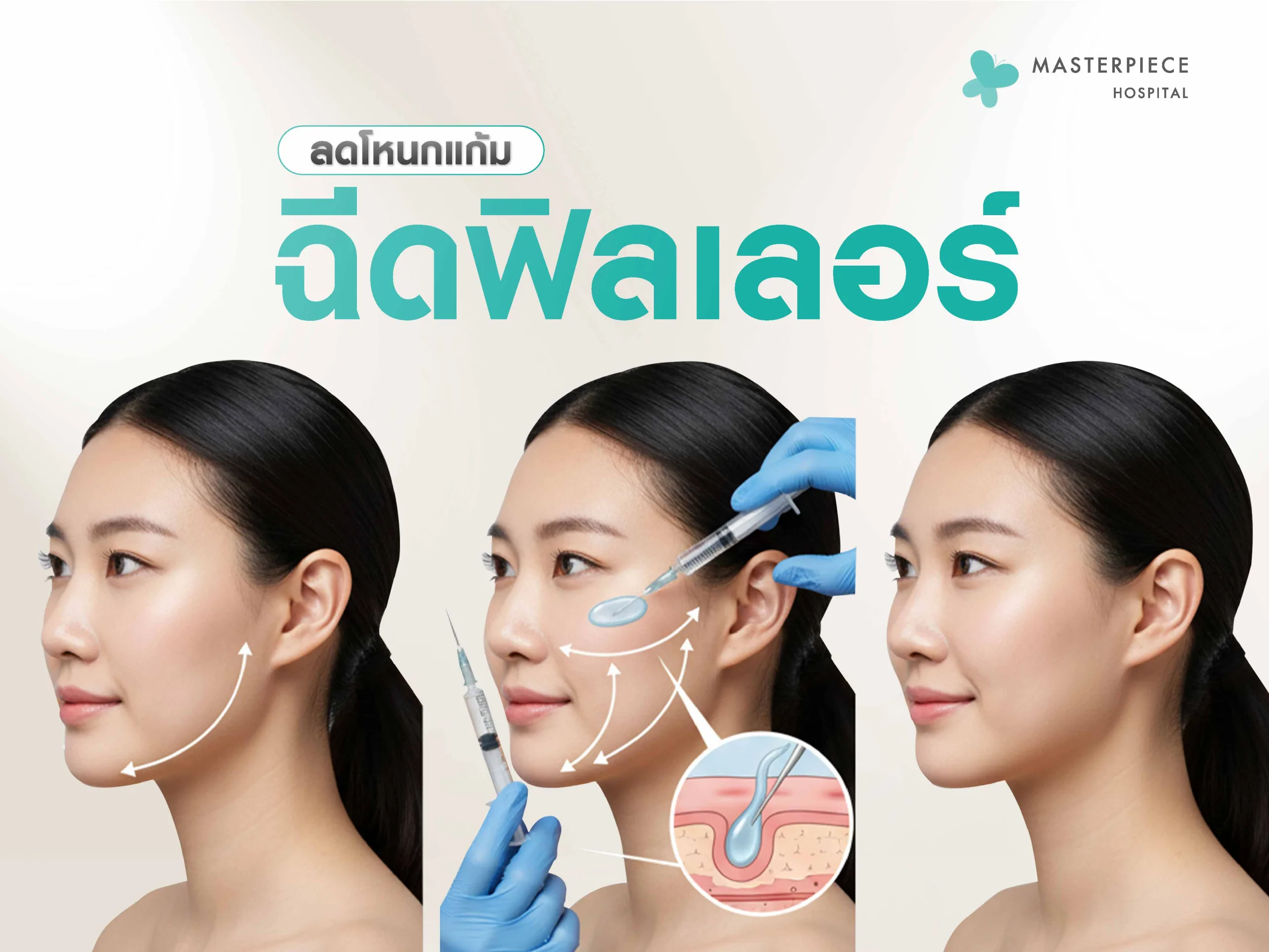 ลดโหนกแก้มด้วยการฉีดฟิลเลอร์