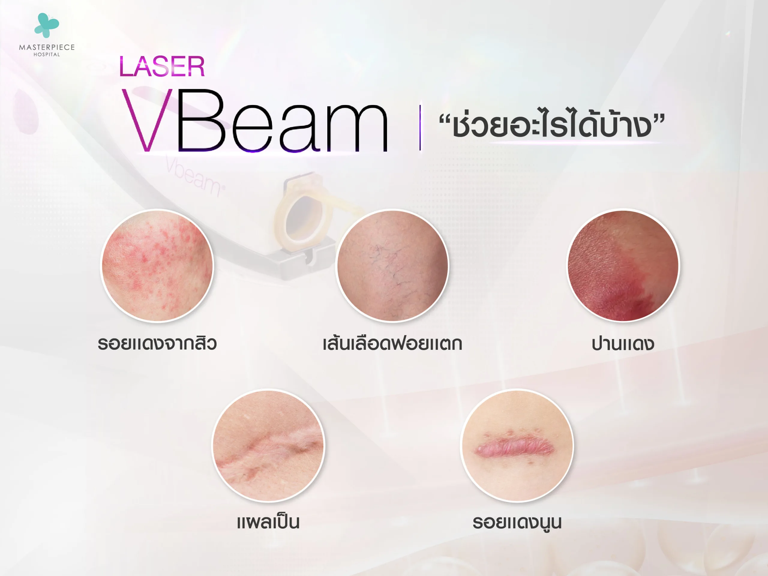 Laser V Beam ช่วยอะไรได้บ้าง