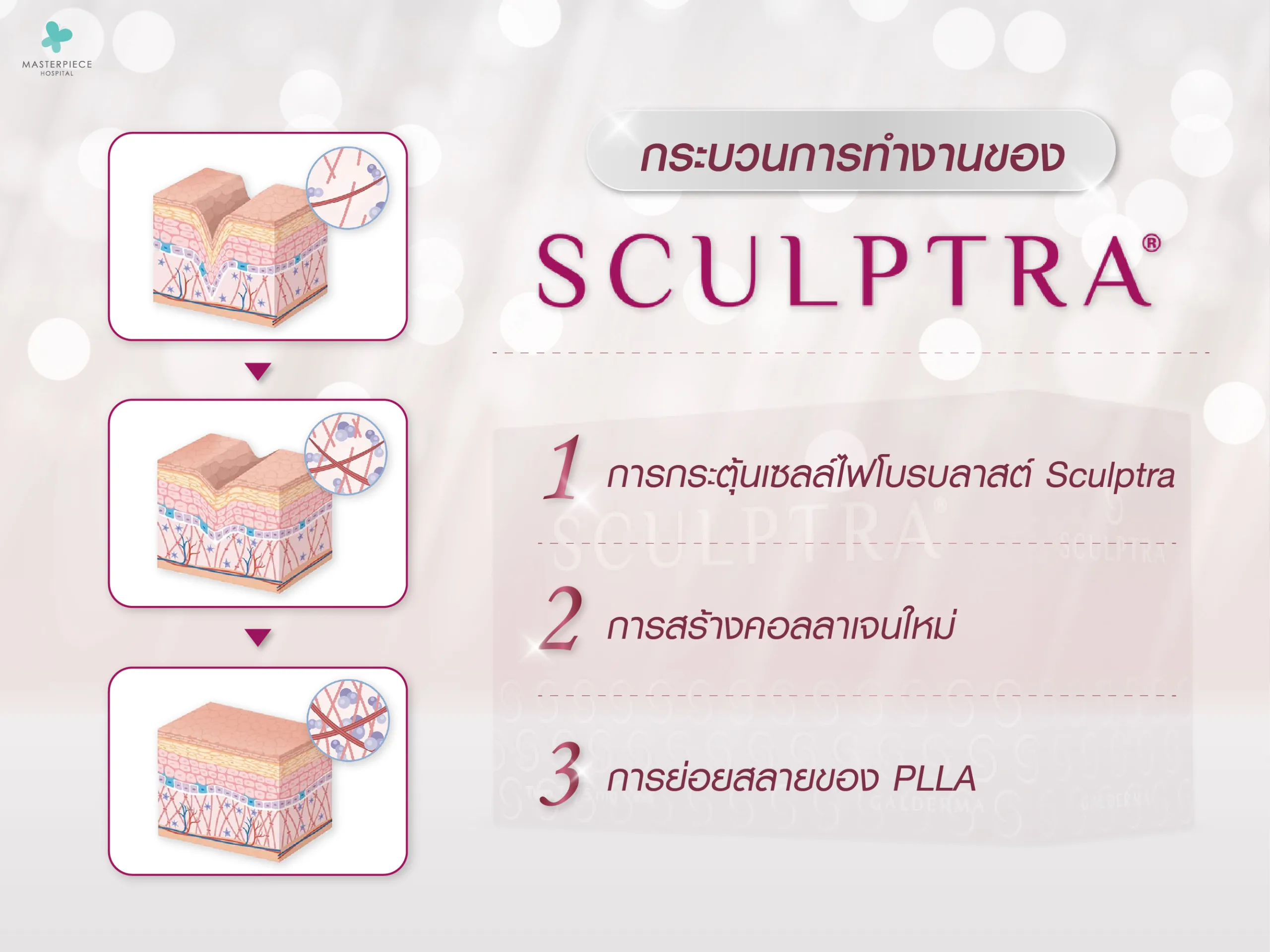 กระบวนการทำงานของ Sculptra