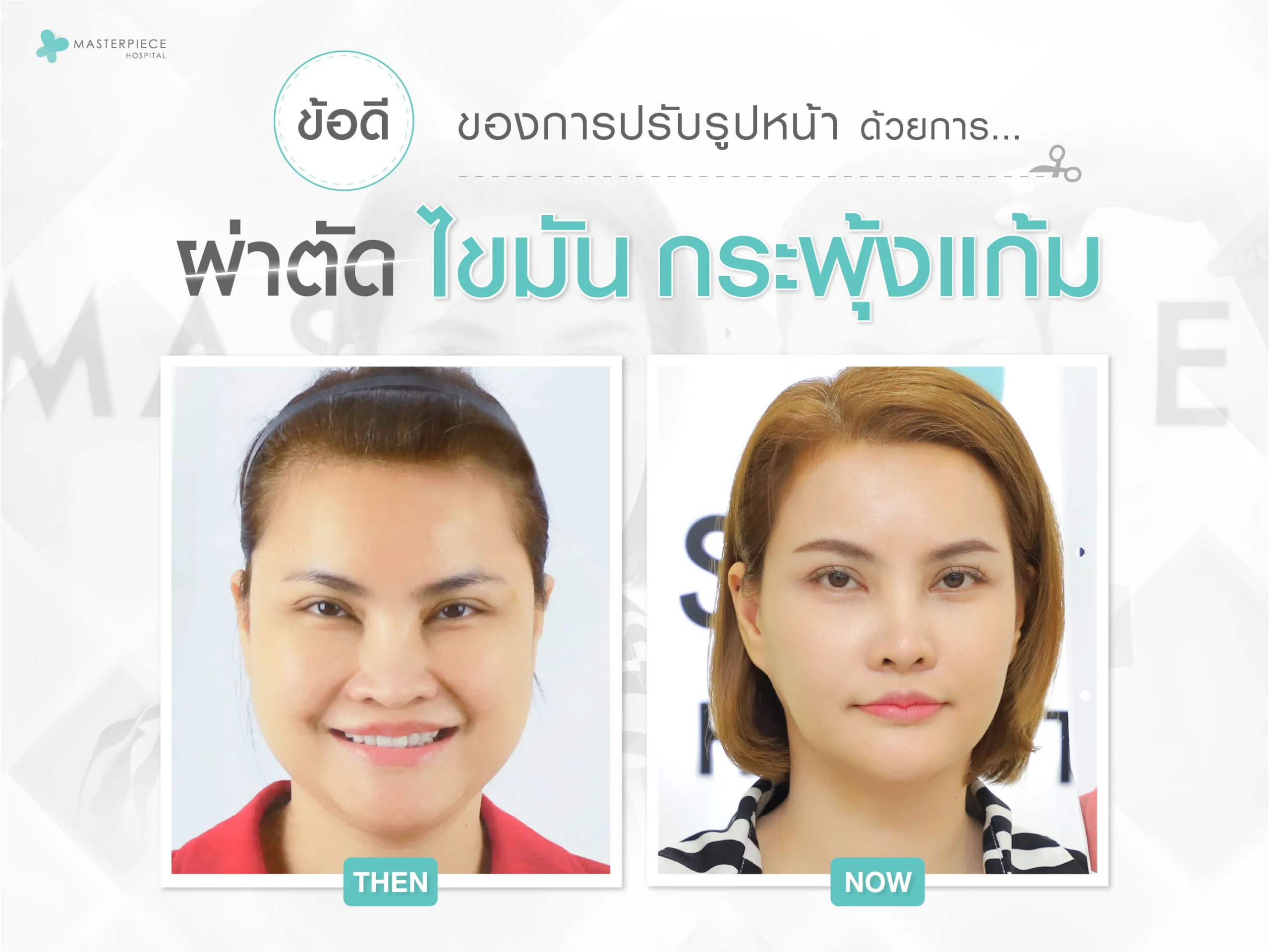 ข้อดีของการปรับรูปหน้า ด้วยการผ่าตัดไขมันกระพุ้งแก้ม
