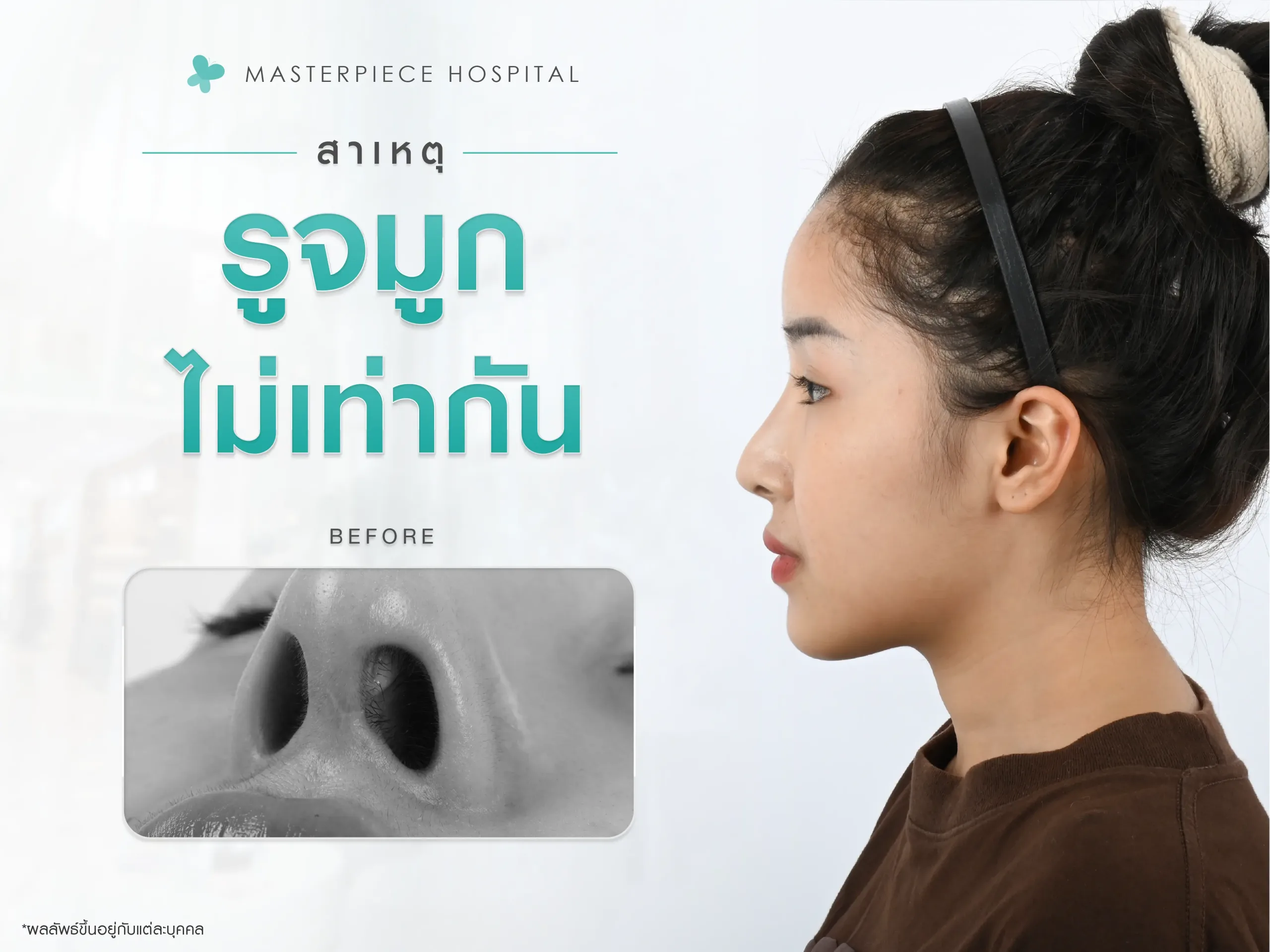 ผู้หญิงเงยหน้าขึ้น เห็นเป็นรูจมูกที่ไม่เท่ากัน กับข้อความ สาเหตุที่ทำให้รูจมูกไม่เท่ากัน