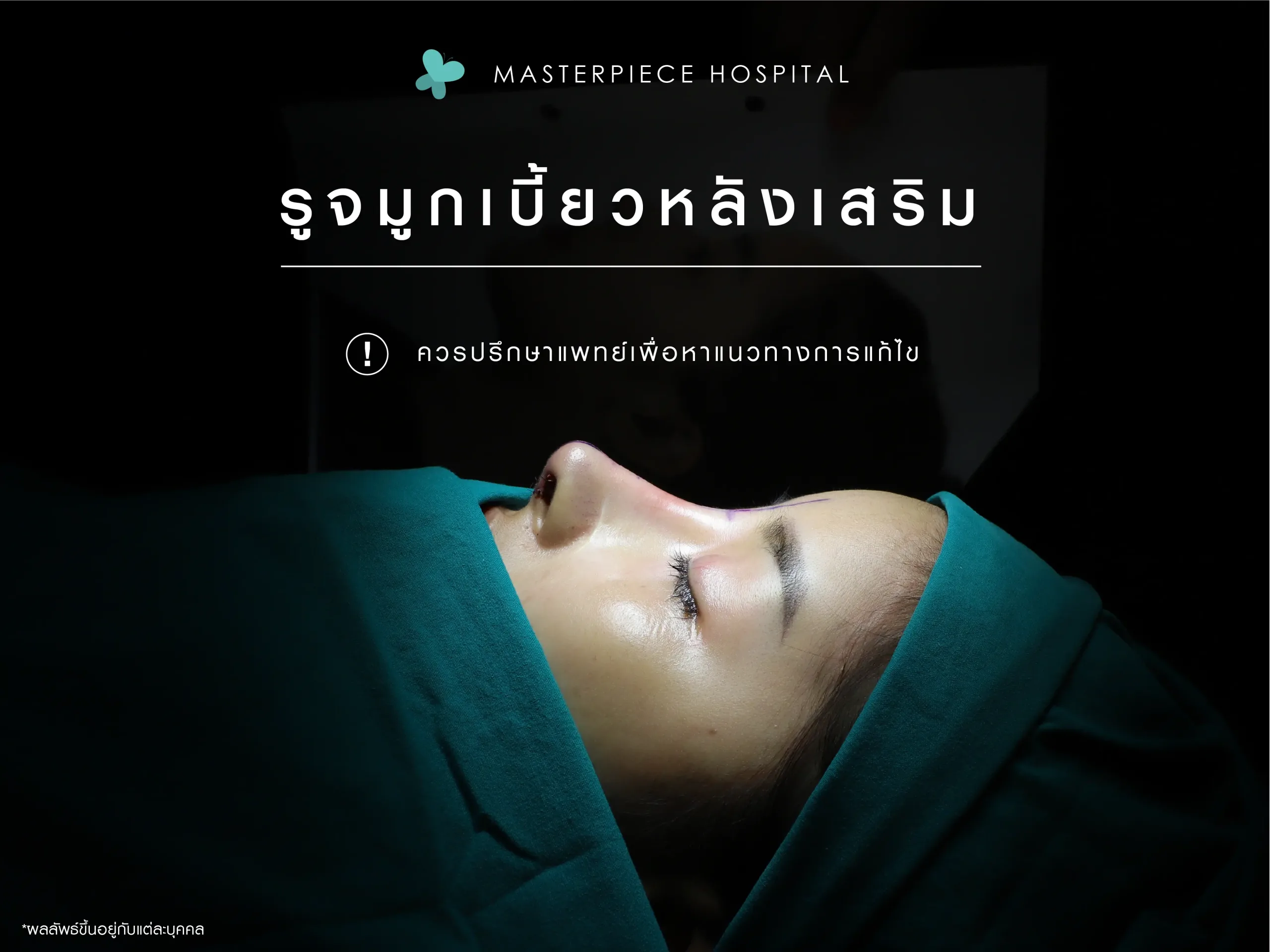 รีวิวการแก้รูจมูกเบี้ยด้วยศัลยกรรมจมูก ได้จมูกเป็นทรง เข้ารูป