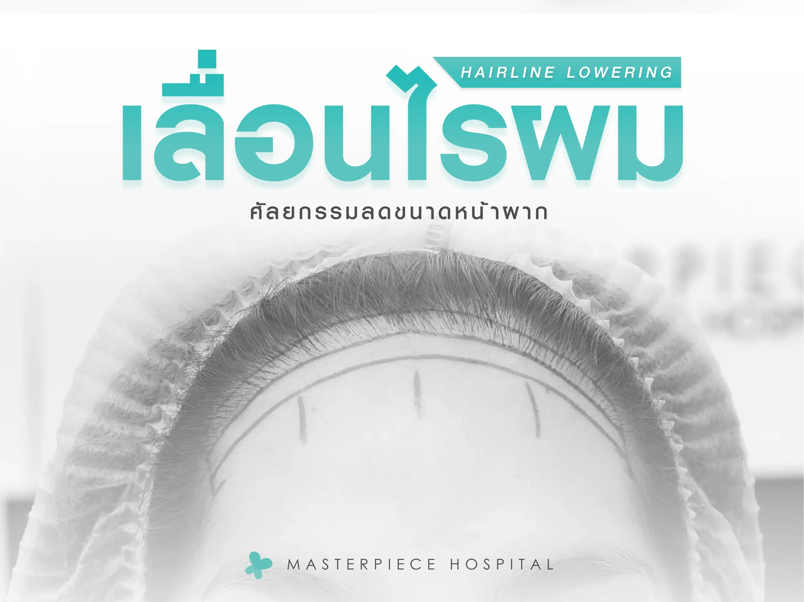 เลื่อนไรผม ลดหน้าผาก คืออะไร เลื่อนไรผม ลดหน้าผาก คืออะไร