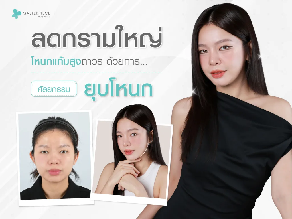 ผู้หญิงหันข้างขณะยิ้ม มีกราฟิกบริเวณโหนกแก้ม แสดงให้เห็นทิศทางทำศัลยกรรมลดโหนกแก้ม