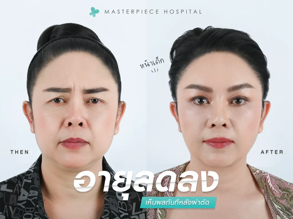 อายุลดลง เห็นผลหลังผ่าตัด