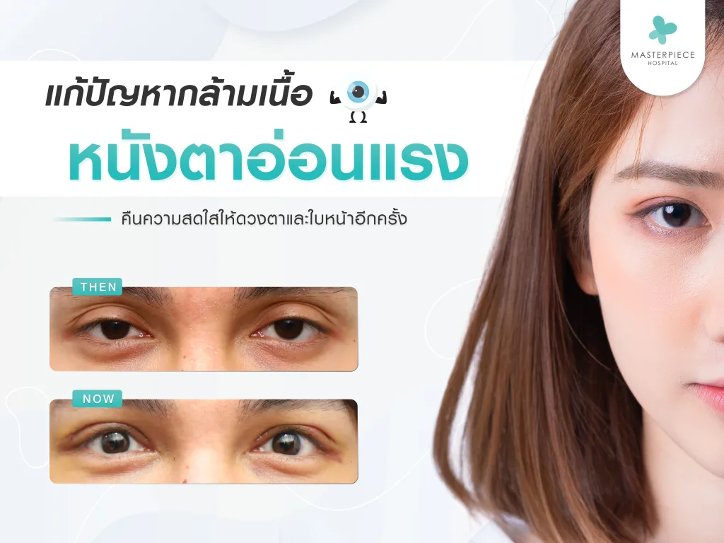 กล้ามเนื้อตาอ่อนแรง