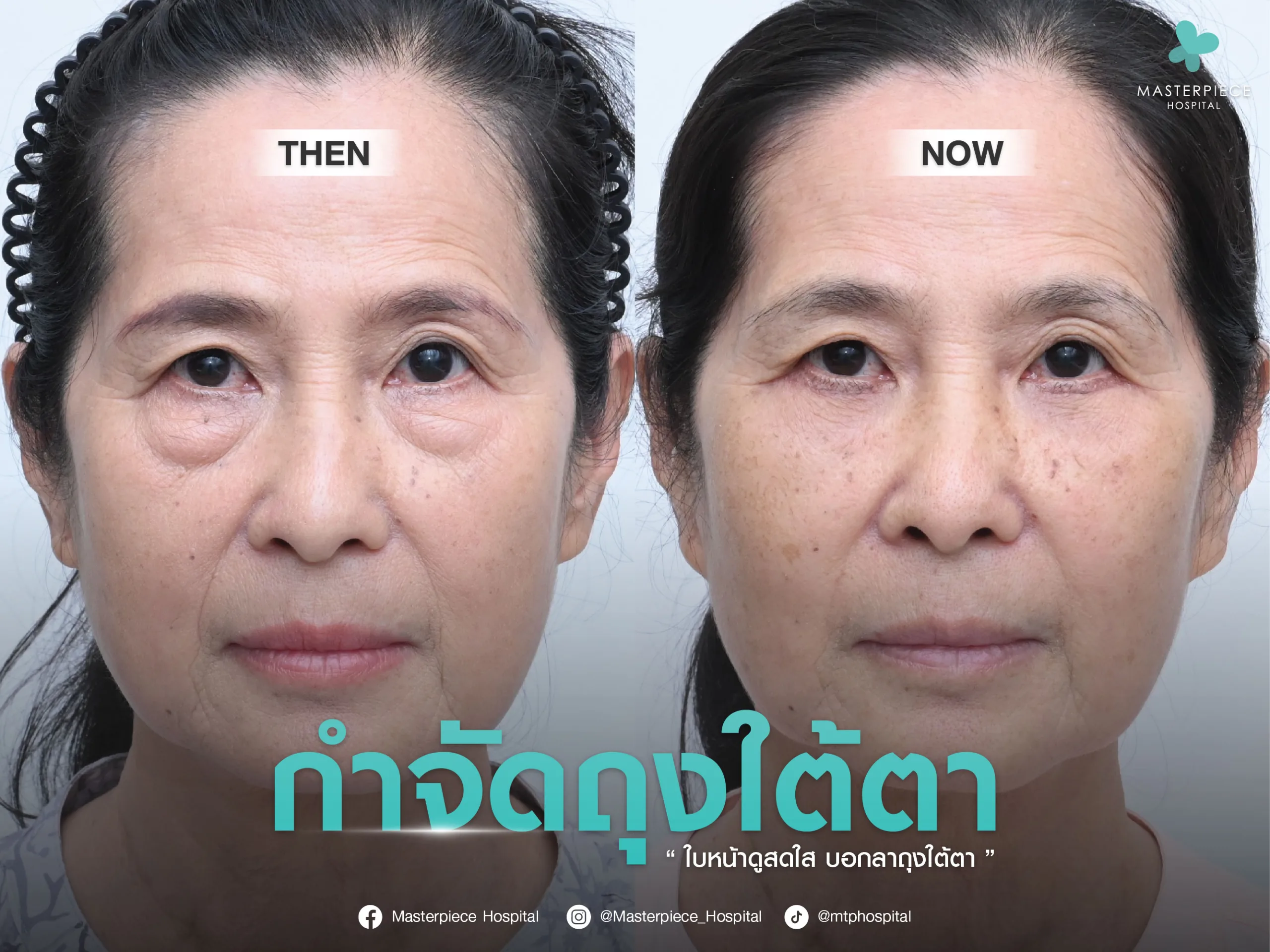 การผ่าตัดถุงใต้ตาเพื่อย้อนวัยให้กลับมาดูสดใสดั่งวัยสาวอีกครั้ง!