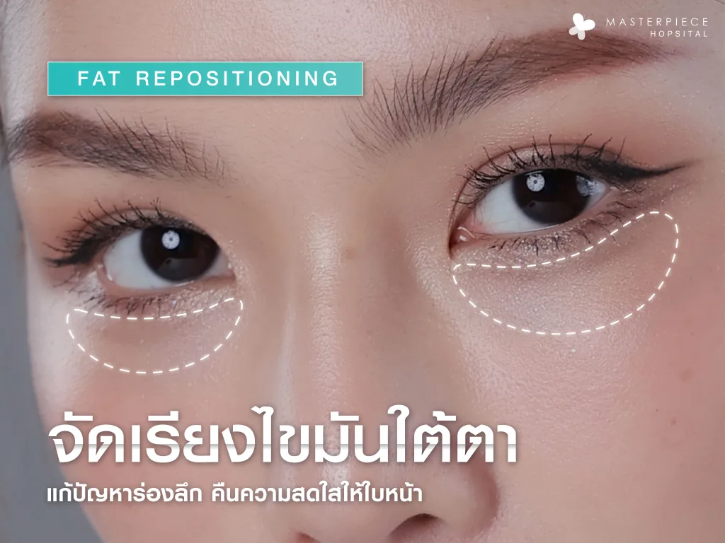 จัดเรียงไขมันใต้ตา (Fat Repositioning) แก้ปัญหาร่องลึก คืนความสดใสให้ใบหน้า
