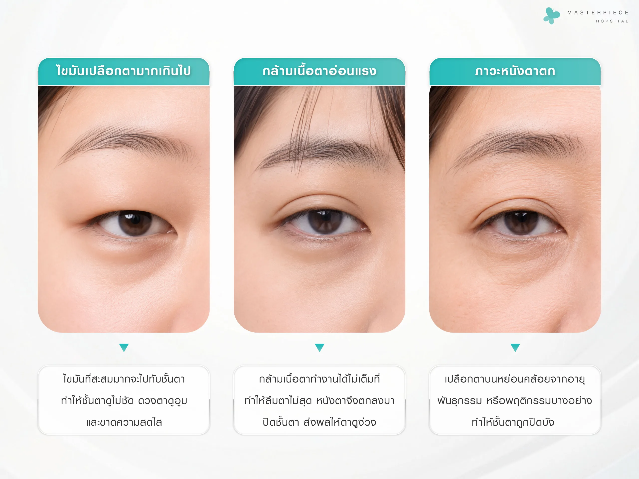 ตาสองชั้นหลบในเกิดจากอะไร