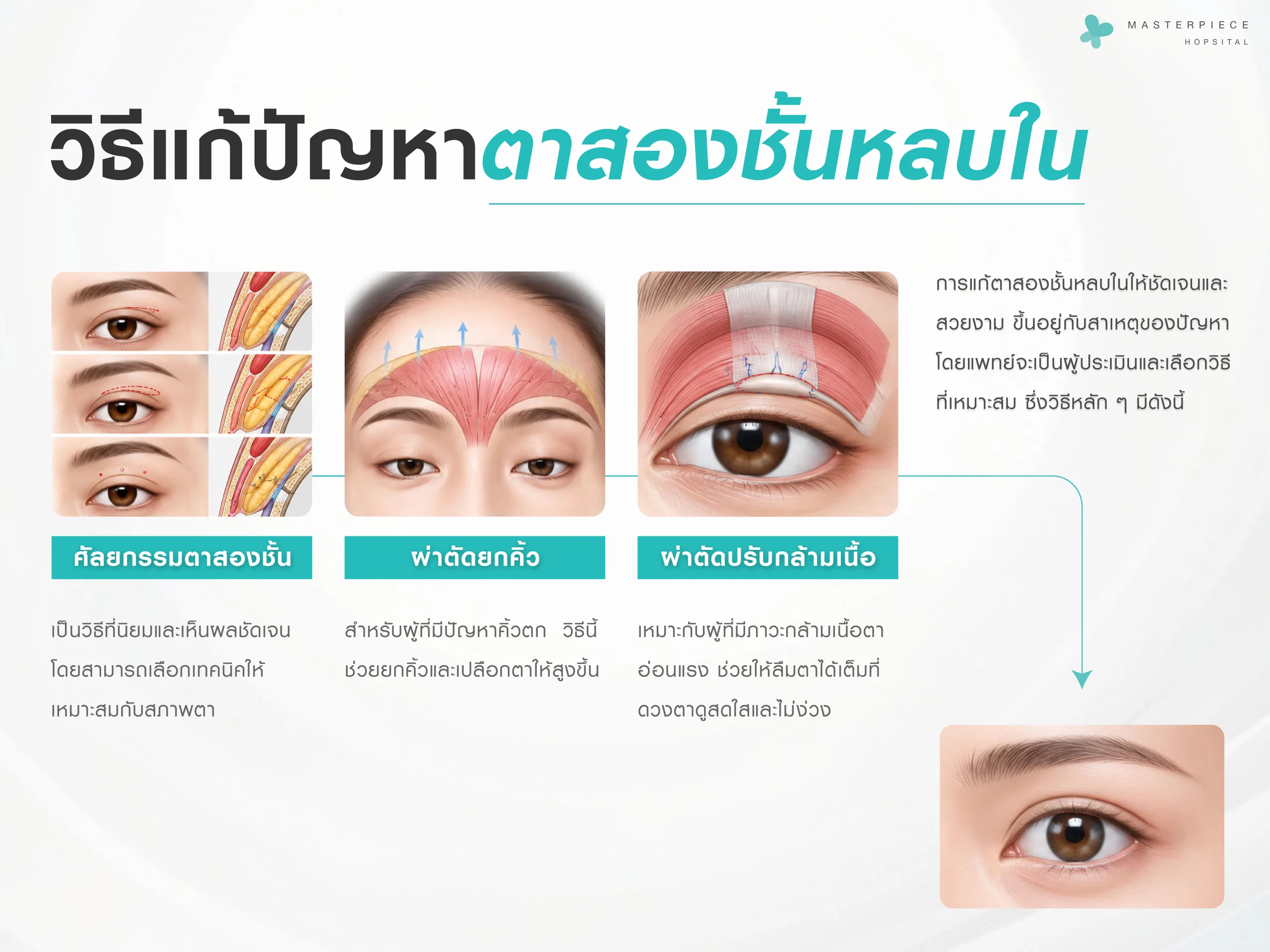วิธีแก้ปัญหาตาสองชั้นหลบใน