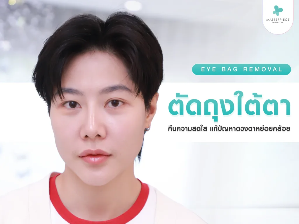 ศัลยกรรมตัดถุงใต้ตา (Eye Bag Removal) คืนความสดใส แก้ปัญหาดวงตาหย่อนคล้อย