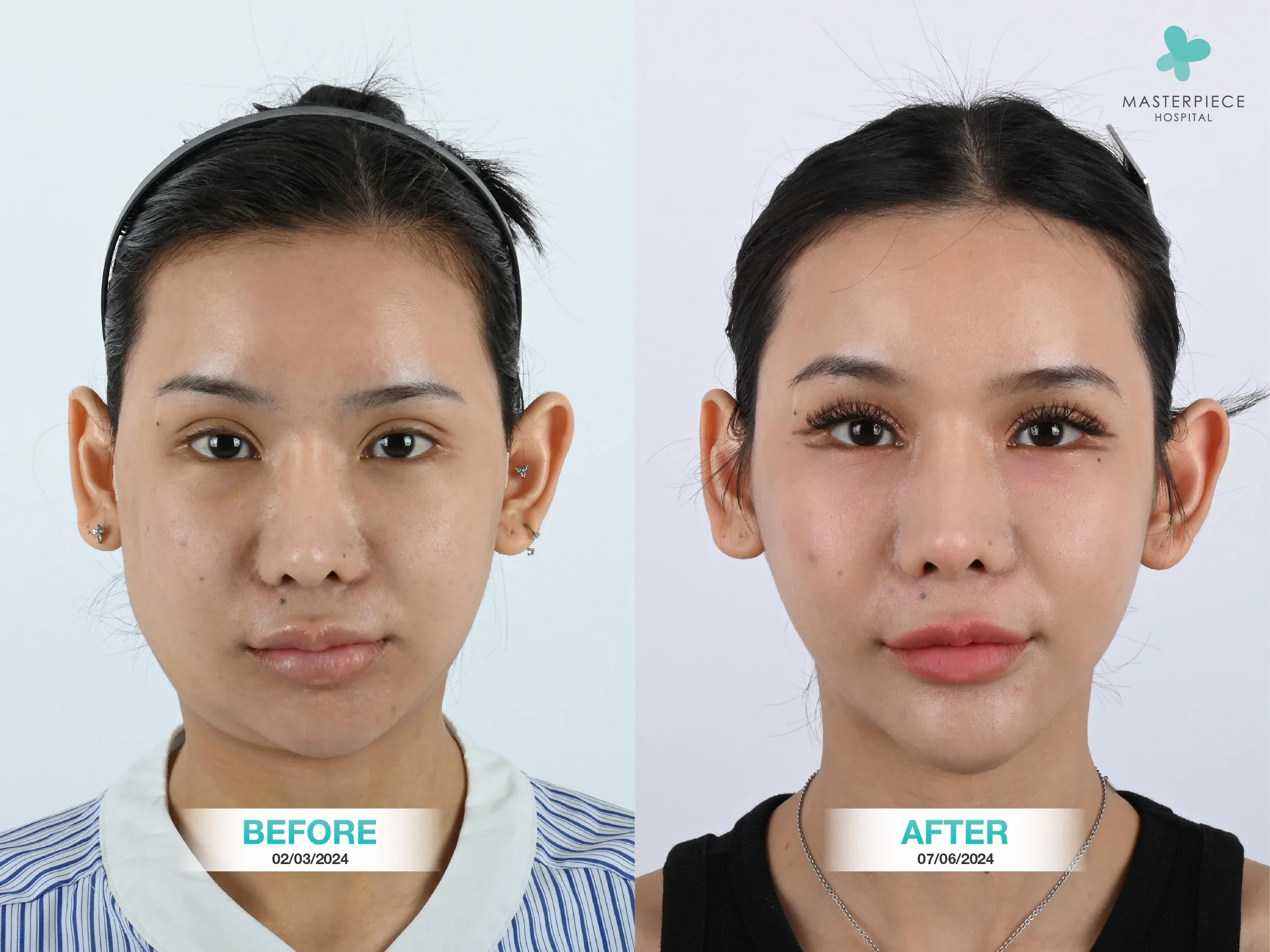ก่อนและหลังทำศัลยกรรมเสริมคาง ด้านซ้ายก่อนทำ คางจะดูสั้น หน้ากลม หลังทำด้านขวาหน้าเรียวเป็น V shape