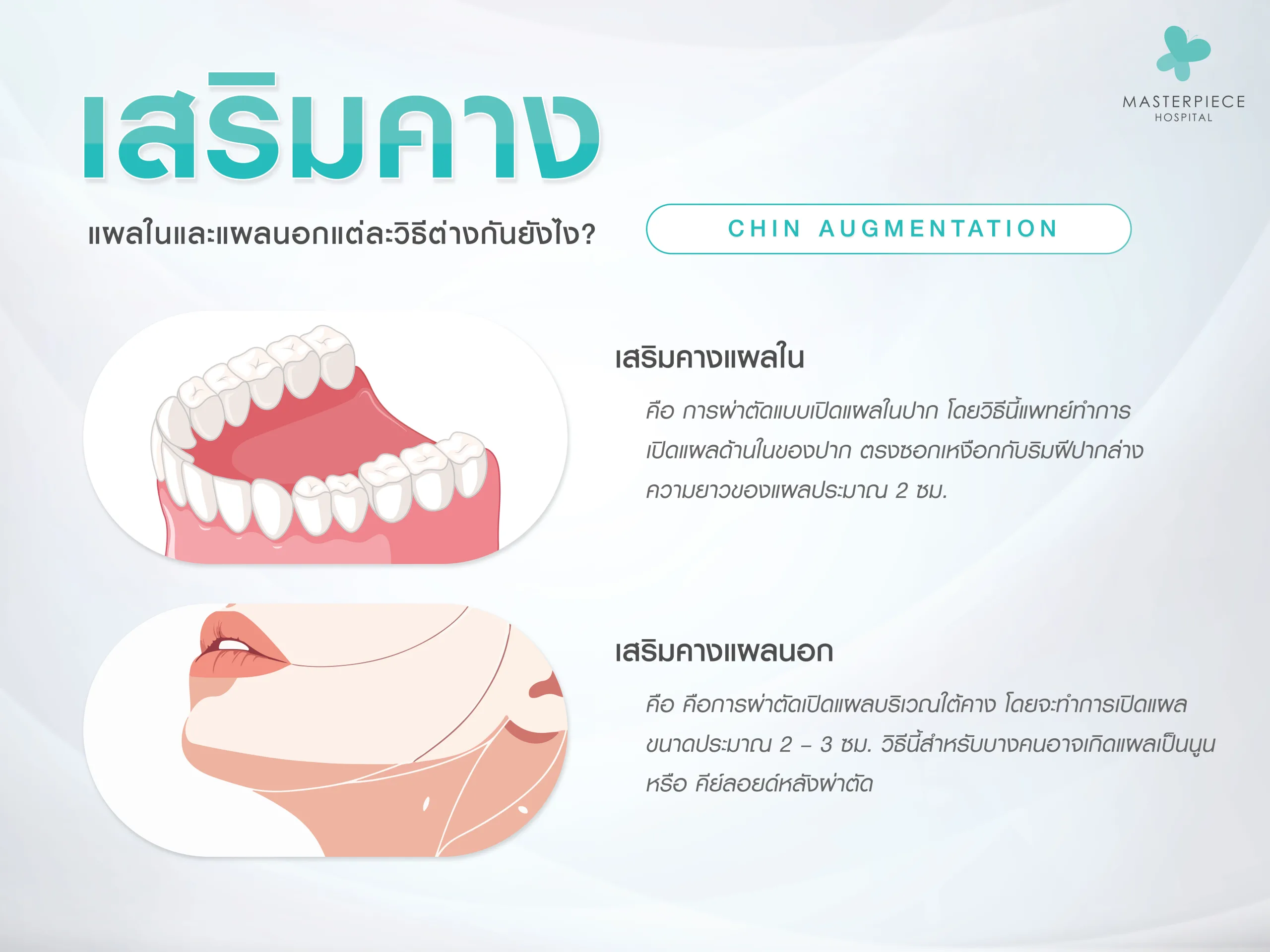 เสริมคางแผลใน หรือ เสริมคางแผลนอก ?