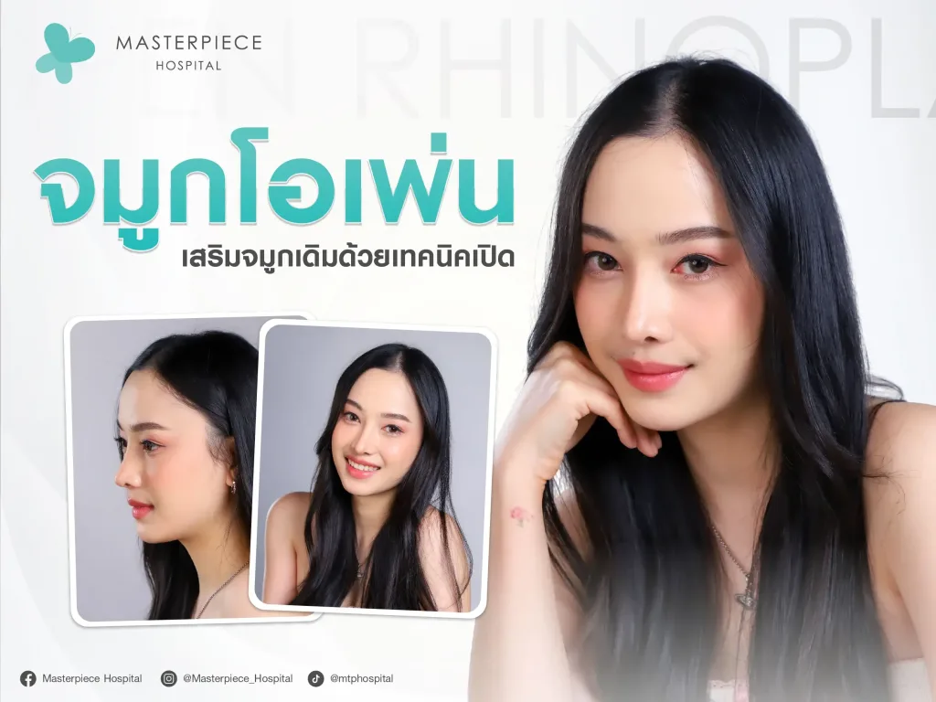 เสริมจมูกแบบโอเพ่นจากทรงจมูกเดิมด้วยเทคนิคแบบเปิด ทำได้ถึงโครงสร้างจมูก