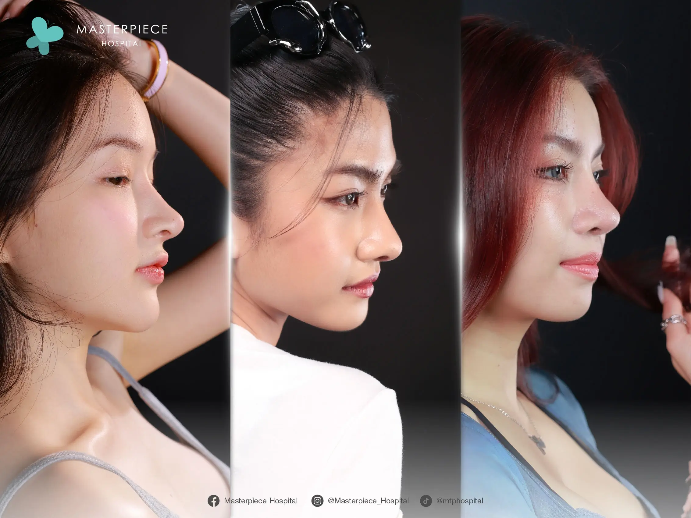 เสริมจมูกแบบโอเพ่นคืออะไร ?