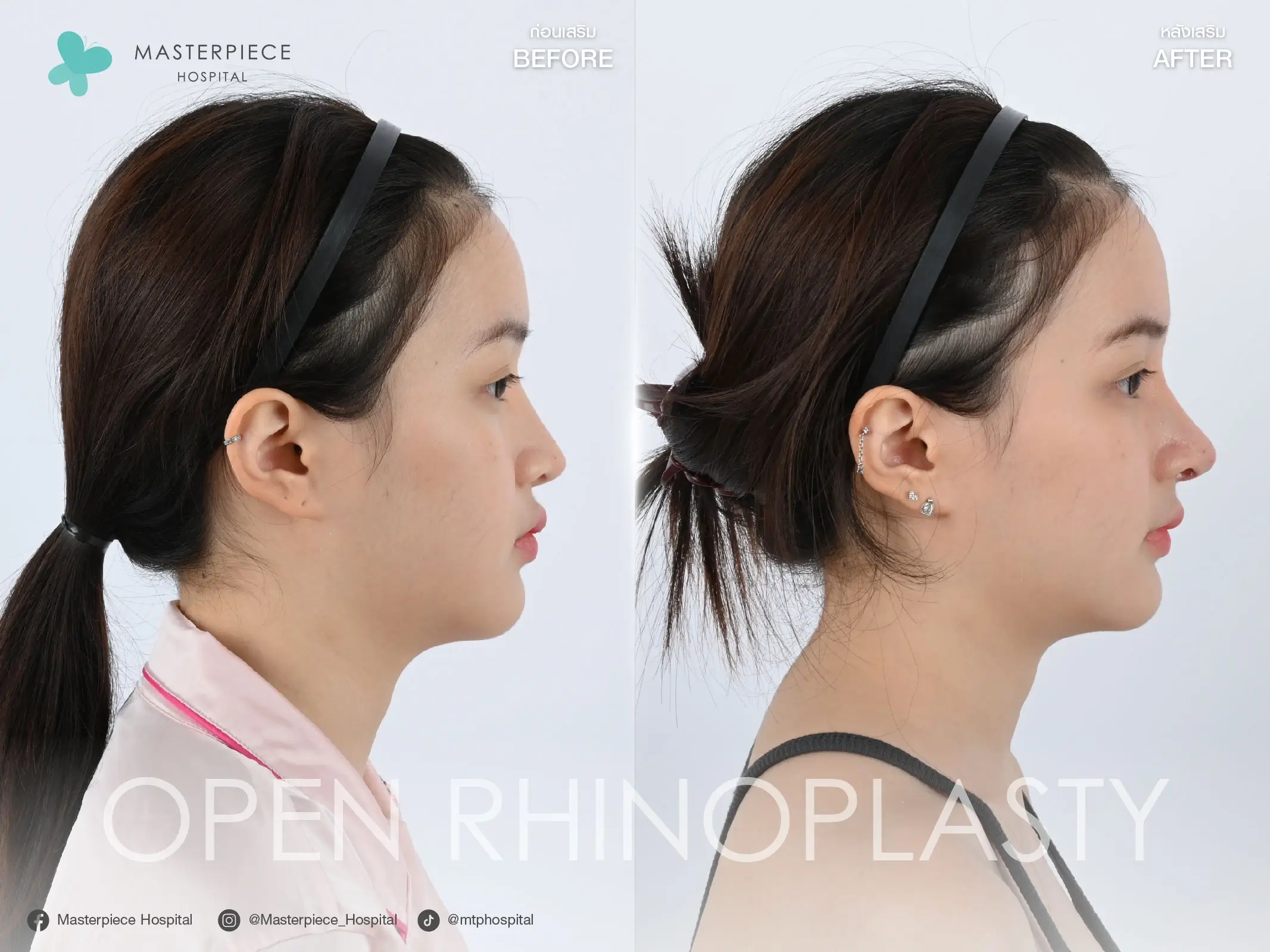 รีวิวแก้จมูกแบบโอเพ่นโดยรวมทั้งหมดไม่เฉพาะแค่ความโด่ง ! จมูกโด่งเด่นอย่างเห็นได้ชัด