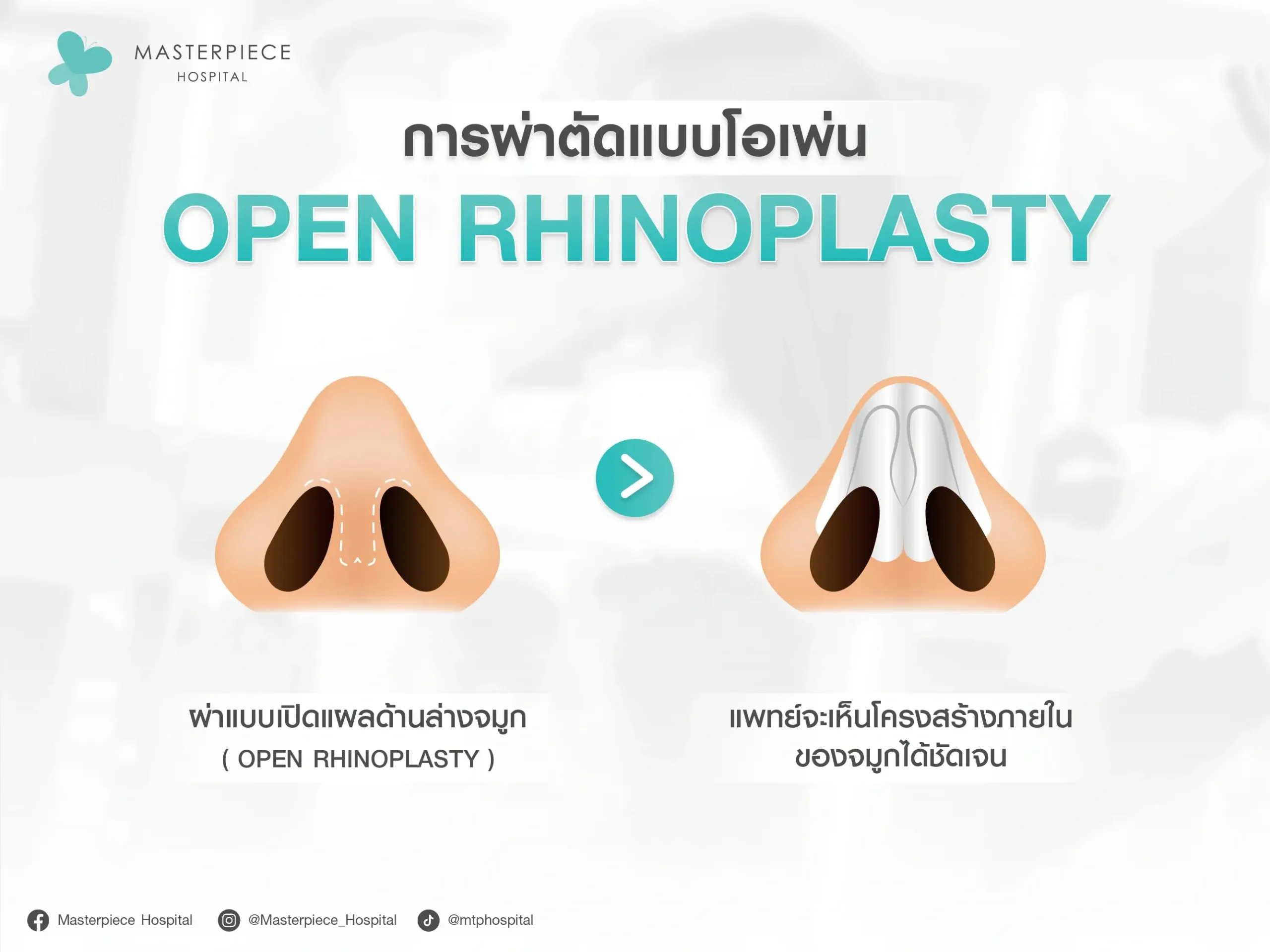 การผ่าตัดแบบ OPEN RHINOPLASTY จะแสดงให้เห็นถึงลักษณะการผ่าเปิดจมูก