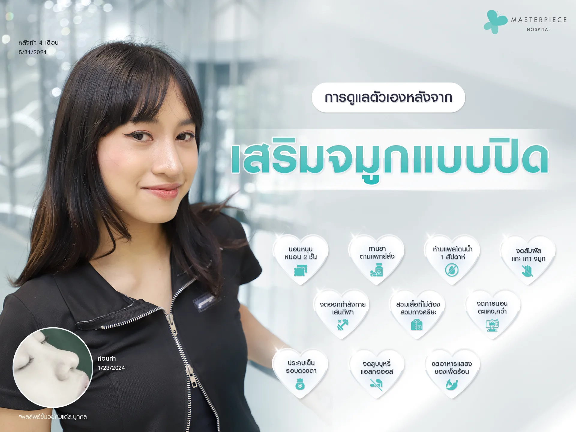 วิธีดูแลหลังเสริมจมูก