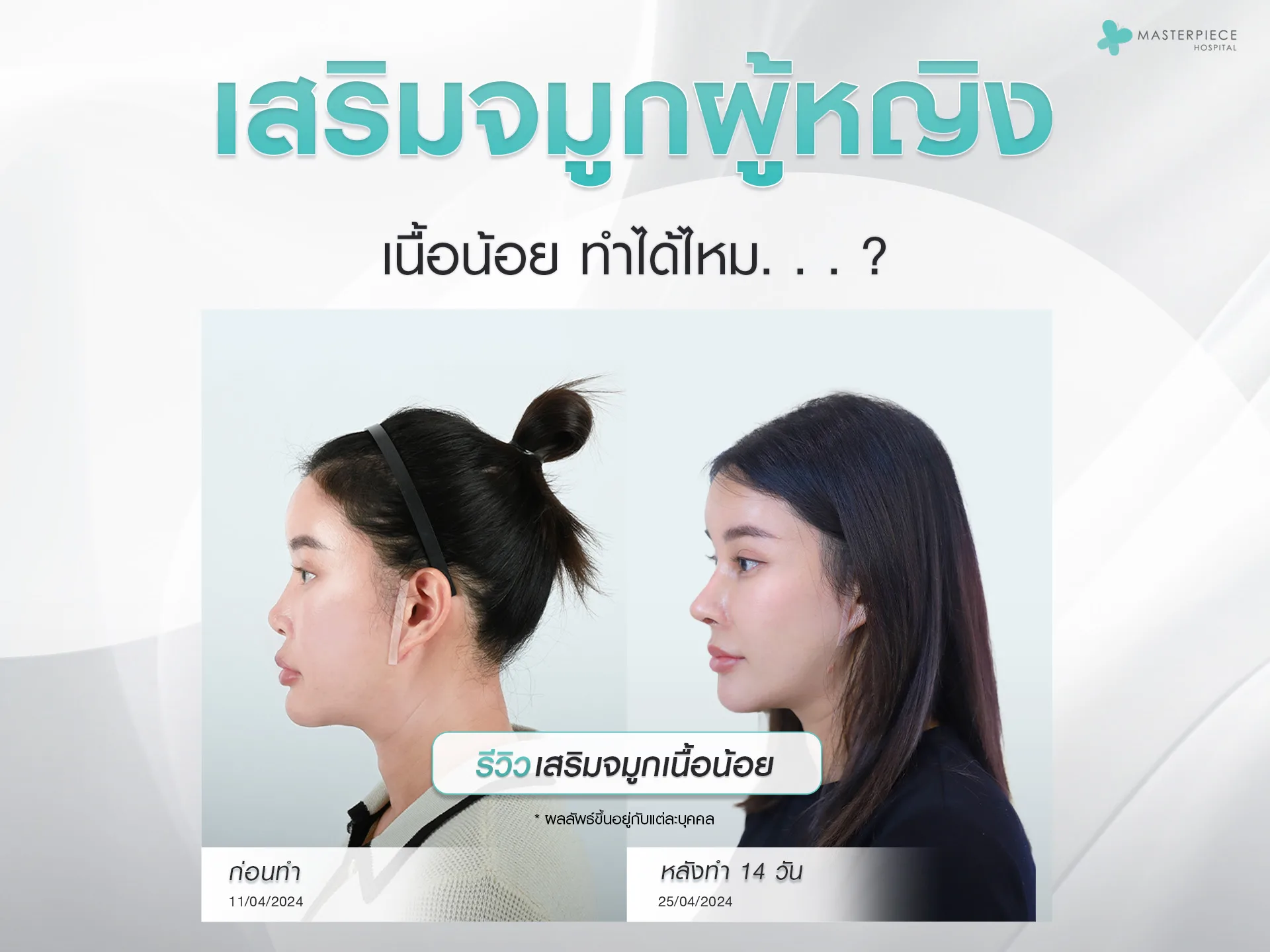 เสริมจมูกผู้หญิงเนื้อน้อย ทำได้ไหม?