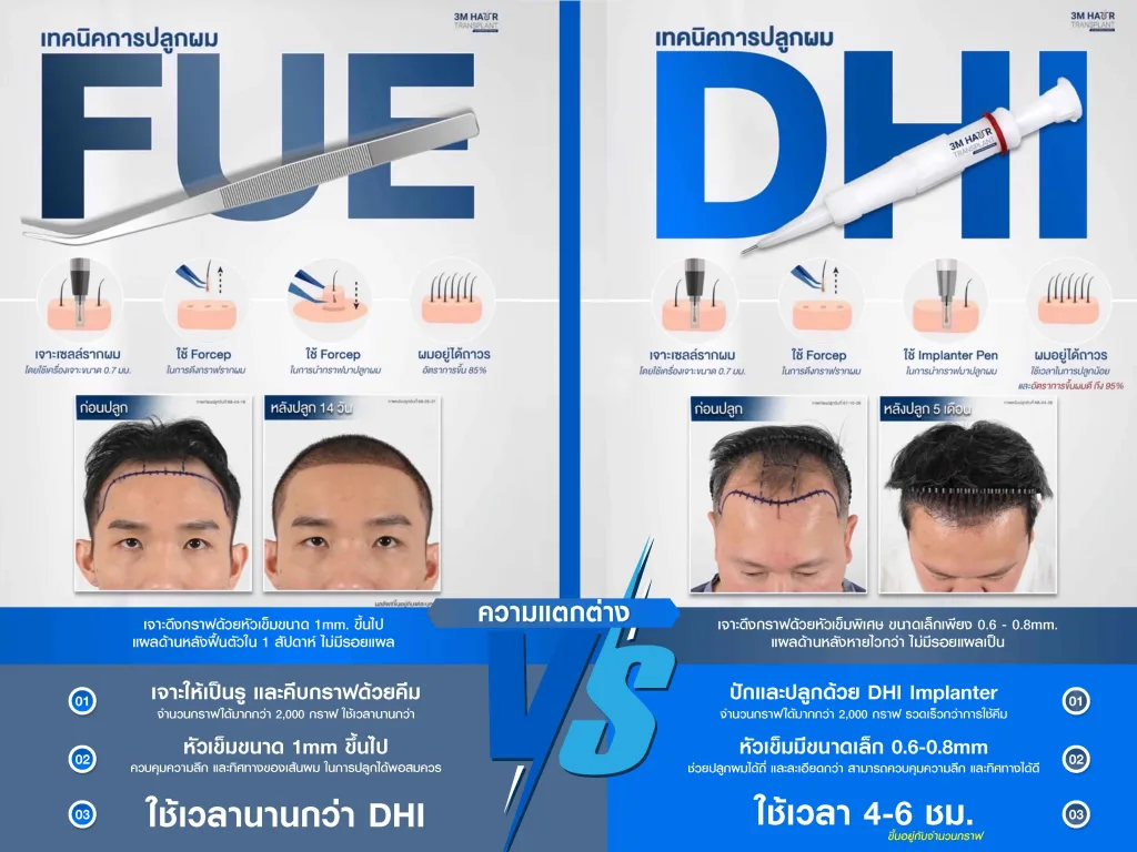 เทคนิคการปลูกผม DMI ที่มีความแม่นยำและเป็นเทคนิคใหม่