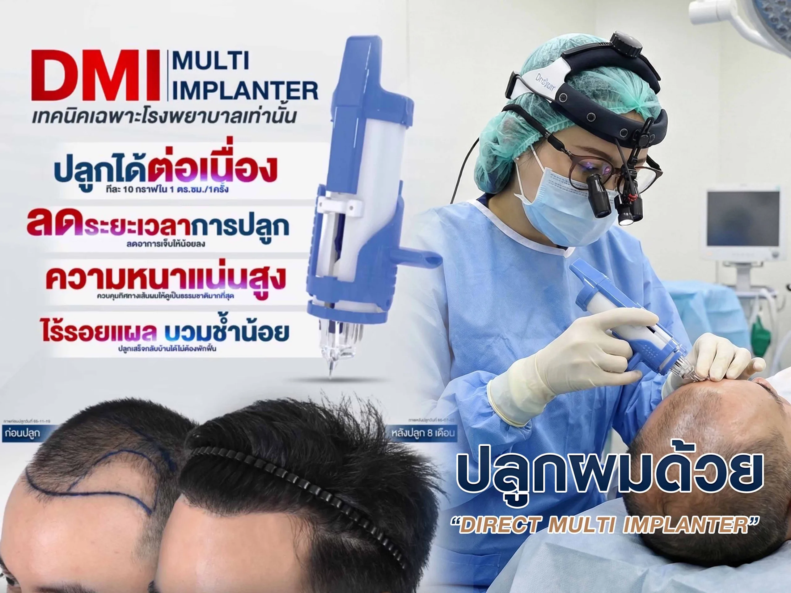 การปลูกผมด้วยเทคนิค DMI เป็นเทคนิคที่มีความแม่นยำสูง ให้ผลดีดูเป็นธรรมชาติ
