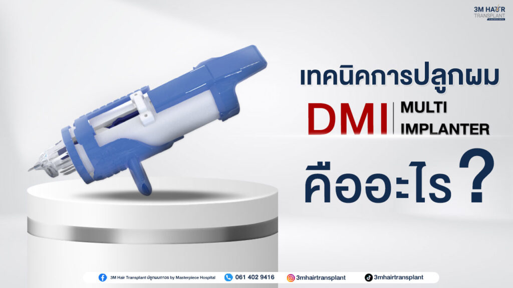 เทคนิคการปลูกผม DMI ที่มีความแม่นยำและเป็นเทคนิคใหม่
