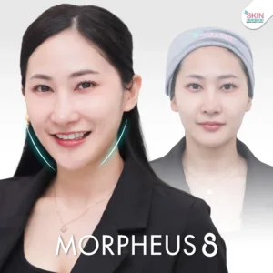 Review morpheus8 1