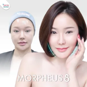 Review morpheus8 2