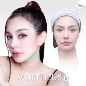 Review morpheus8 3