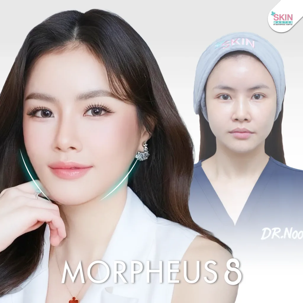 Review morpheus8 4