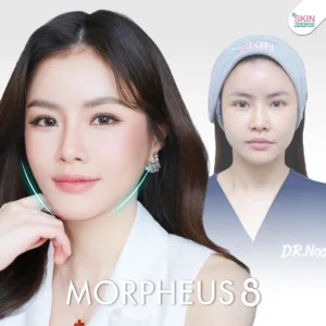 Review morpheus8 4